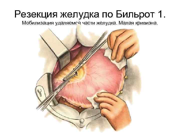 Резекция желудка по Бильрот 1. Мобилизация удаляемой части желудка. Малая кривизна. 