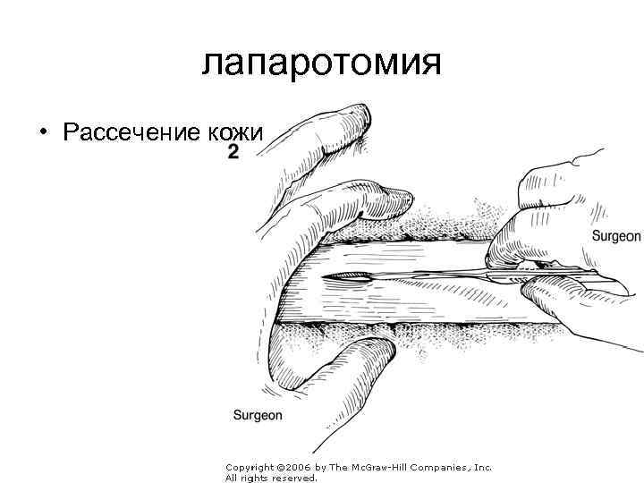 лапаротомия • Рассечение кожи 