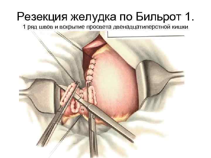 Резекция желудка по Бильрот 1. 1 ряд швов и вскрытие просвета двенадцатиперстной кишки 