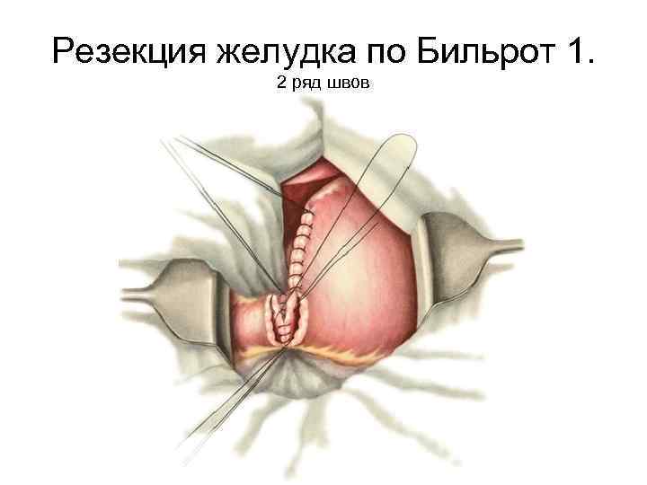 Резекция желудка по Бильрот 1. 2 ряд швов 