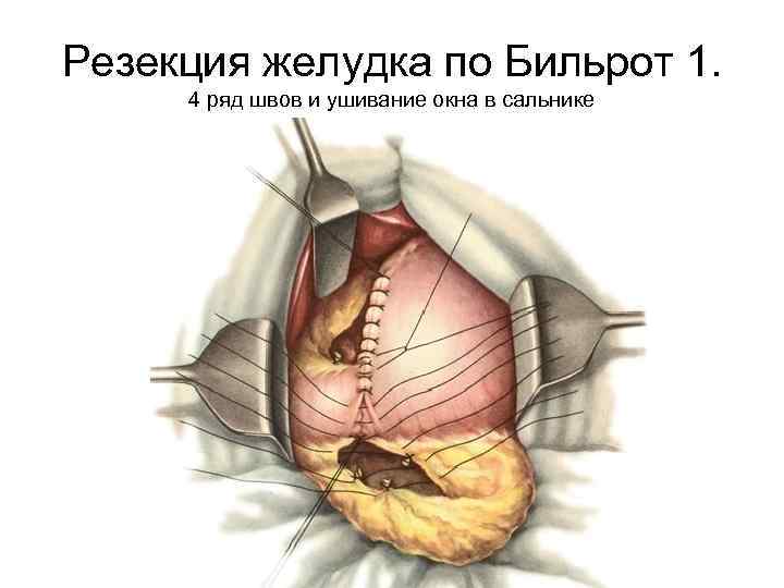 Резекция желудка по Бильрот 1. 4 ряд швов и ушивание окна в сальнике 