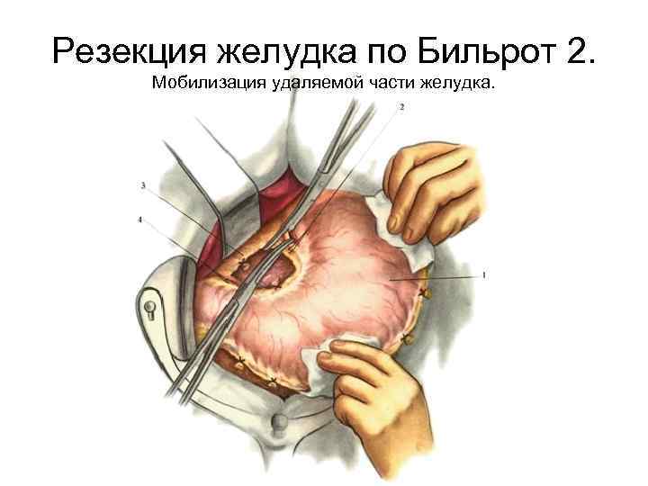 Резекция желудка по Бильрот 2. Мобилизация удаляемой части желудка. 
