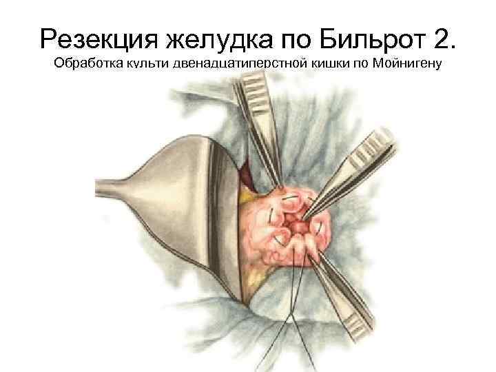 Резекция желудка по Бильрот 2. Обработка культи двенадцатиперстной кишки по Мойнигену 