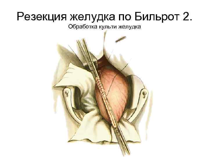 Резекция желудка по Бильрот 2. Обработка культи желудка 