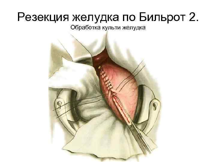 Резекция желудка по Бильрот 2. Обработка культи желудка 