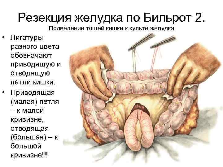 Резекция желудка по Бильрот 2. Подведение тощей кишки к культе желудка • Лигатуры разного