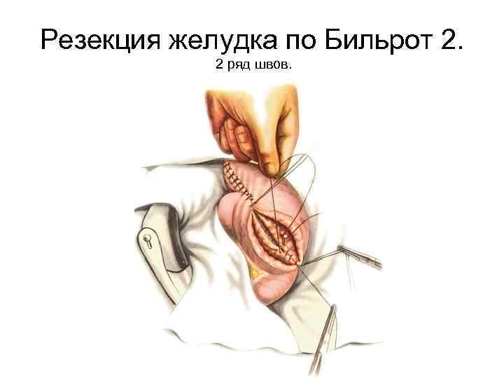 Резекция желудка по Бильрот 2. 2 ряд швов. 
