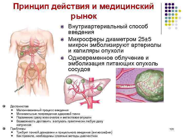 Принцип действия и медицинский рынок Внутриартериальный способ введения Микросферы диаметром 25± 5 микрон эмболизируют