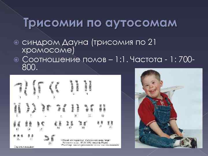 Трисомии по аутосомам синдром Дауна (трисомия по 21 хромосоме) Соотношение полов – 1: 1.