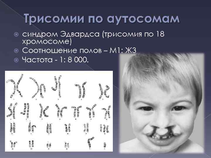 Трисомии по аутосомам синдром Эдвардса (трисомия по 18 хромосоме) Соотношение полов – М 1: