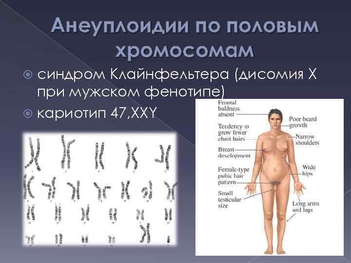 Анеуплоидии по половым хромосомам синдром Клайнфельтера (дисомия Х при мужском фенотипе) кариотип 47, XXY