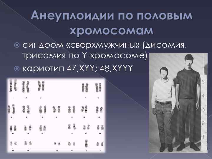 Анеуплоидии по половым хромосомам синдром «сверхмужчины» (дисомия, трисомия по Y-хромосоме) кариотип 47, XYY; 48,