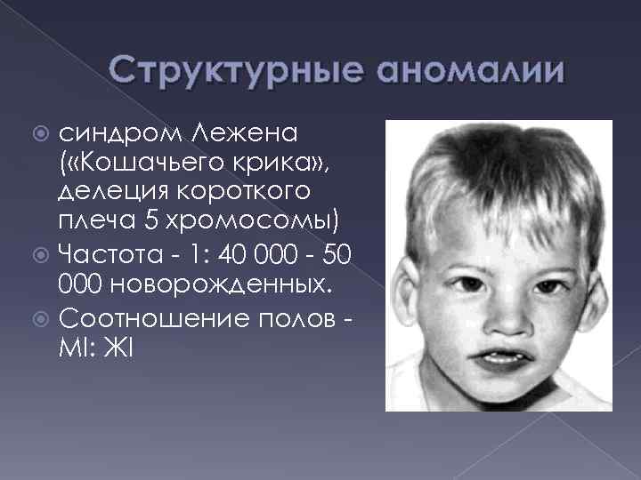 Структурные аномалии синдром Лежена ( «Кошачьего крика» , делеция короткого плеча 5 хромосомы) Частота