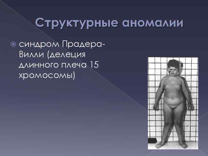 Структурные аномалии синдром Прадера. Вилли (делеция длинного плеча 15 хромосомы) 