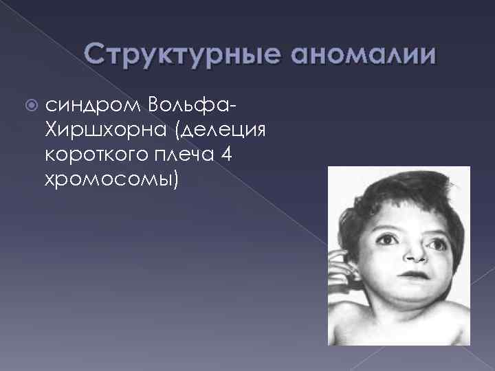 Структурные аномалии синдром Вольфа. Хиршхорна (делеция короткого плеча 4 хромосомы) 