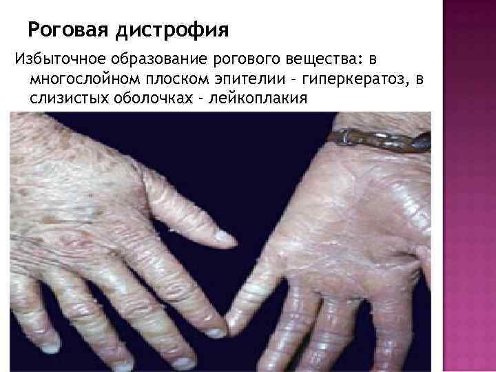 Роговая дистрофия Избыточное образование рогового вещества: в многослойном плоском эпителии – гиперкератоз, в слизистых