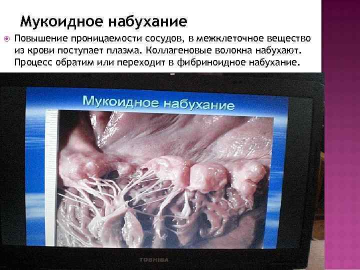 Мукоидное набухание Повышение проницаемости сосудов, в межклеточное вещество из крови поступает плазма. Коллагеновые волокна