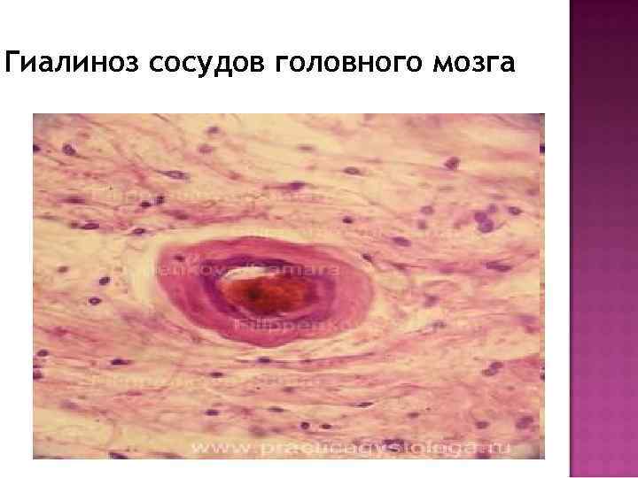 Гиалиноз сосудов головного мозга 