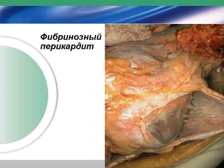 Фибринозный перикардит 