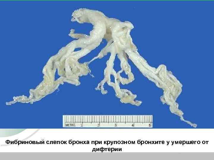 Фибриновый слепок бронха при крупозном бронхите у умершего от дифтерии 