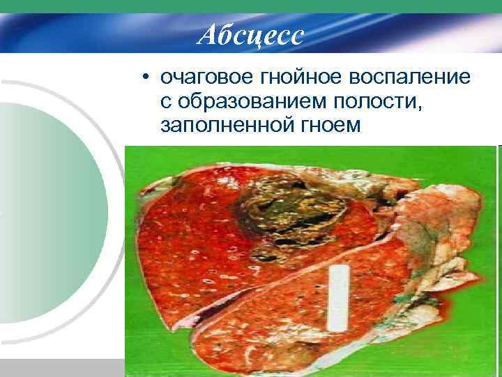 Абсцесс • очаговое гнойное воспаление с образованием полости, заполненной гноем 