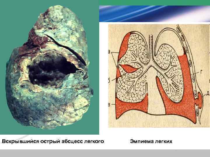 Вскрывшийся острый абсцесс легкого Эмпиема легких 