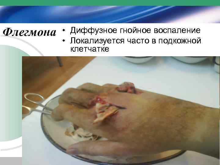 Флегмона • Диффузное гнойное воспаление • Локализуется часто в подкожной клетчатке 