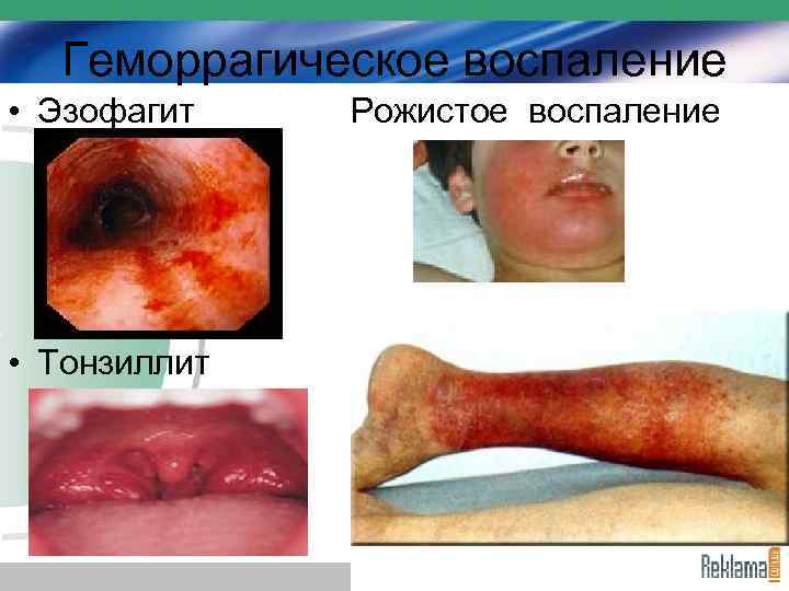 Геморрагическое воспаление • Эзофагит • Тонзиллит Рожистое воспаление 