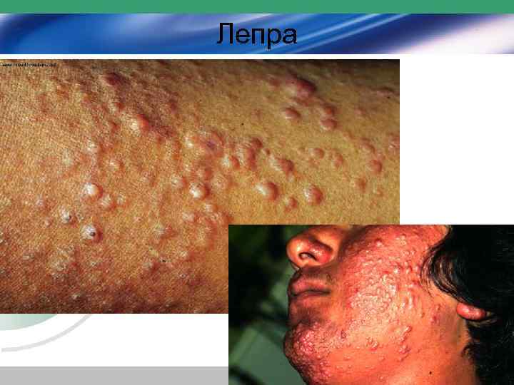 Лепра 