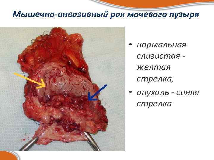 Мышечно-инвазивный рак мочевого пузыря • нормальная слизистая желтая стрелка, • опухоль - синяя стрелка