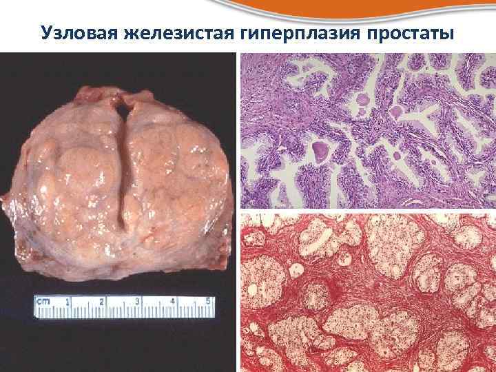 Узловая железистая гиперплазия простаты 