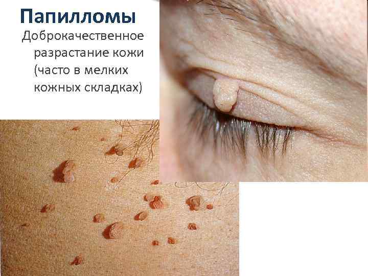 Папилломы Доброкачественное разрастание кожи (часто в мелких кожных складках) 