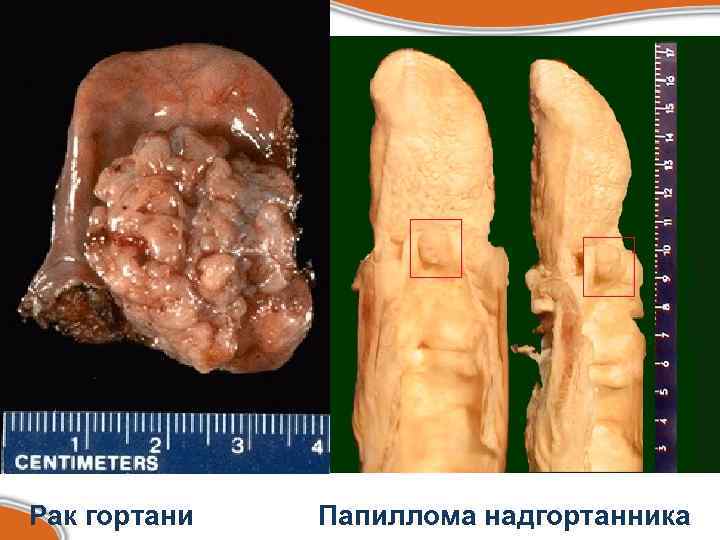 Рак гортани Папиллома надгортанника 