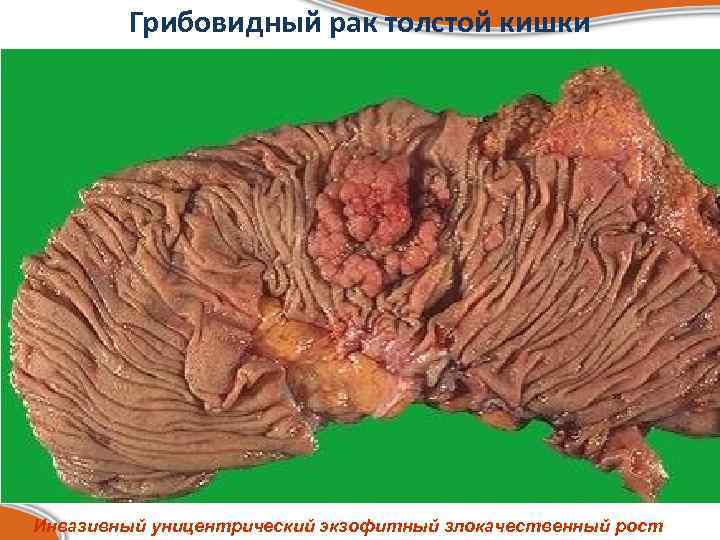 Грибовидный рак толстой кишки Инвазивный уницентрический экзофитный злокачественный рост 