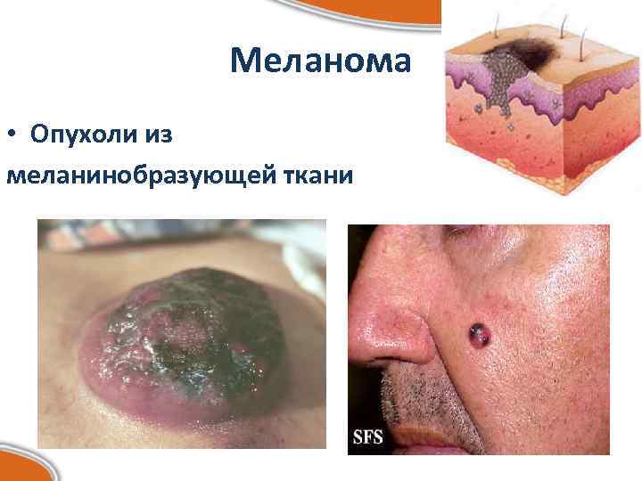 Меланома • Опухоли из меланинобразующей ткани 