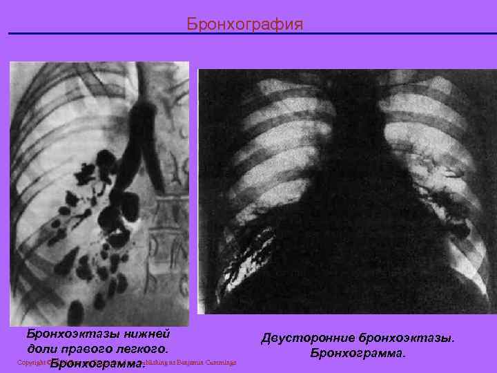 Бронхография Бронхоэктазы нижней доли правого легкого. Copyright © 2004 Pearson Education, Inc. , publishing