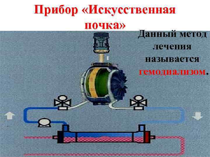 Прибор «Искусственная почка» Данный метод лечения называется гемодиализом. 