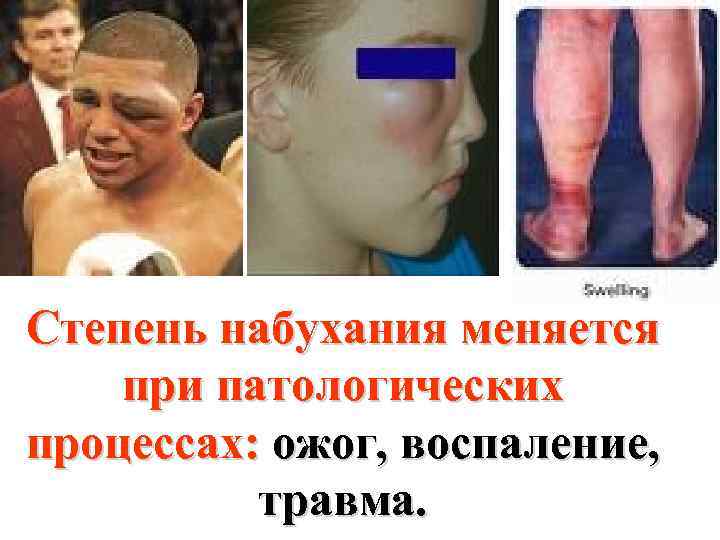 Степень набухания меняется при патологических процессах: ожог, воспаление, травма. 