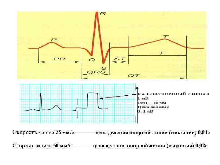 Скорость записи 25 мм/с ------цена деления опорной линии (изолинии) 0, 04 с Скорость записи
