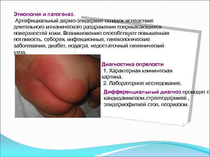 Этиология и патогенез. Артефициальный дермо-эпидермит складок вследствие длительного механического раздражения соприкасающихся поверхностей кожи. Возникновению