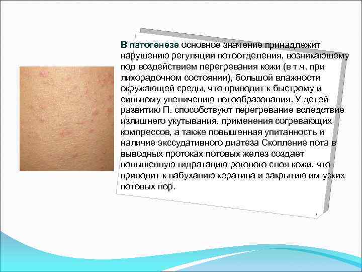 В патогенезе основное значение принадлежит нарушению регуляции потоотделения, возникающему под воздействием перегревания кожи (в