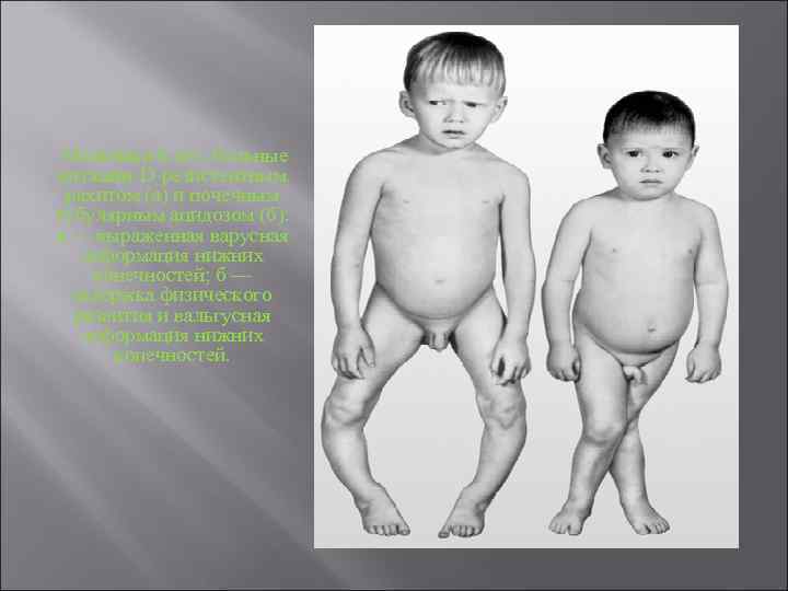  Мальчики 6 лет, больные витамин-D-резистентным рахитом (а) и почечным тубулярным ацидозом (б): а