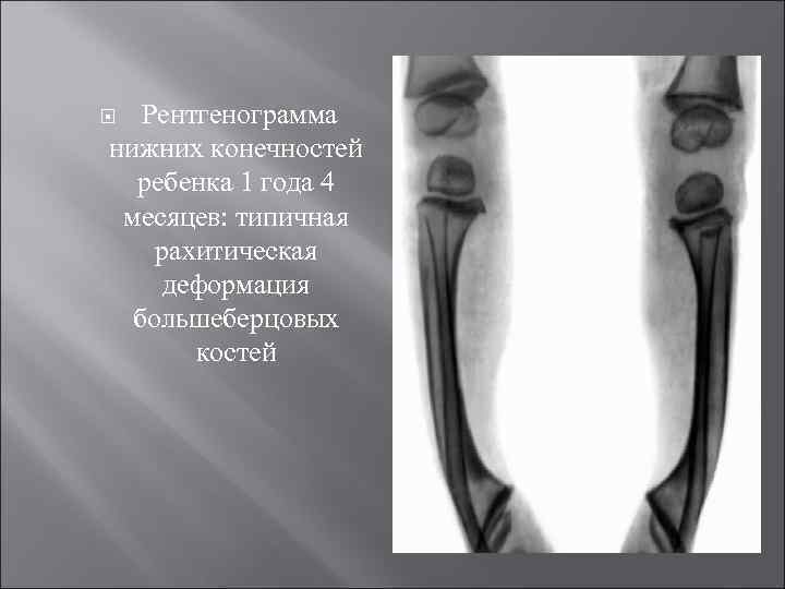  Рентгенограмма нижних конечностей ребенка 1 года 4 месяцев: типичная рахитическая деформация большеберцовых костей