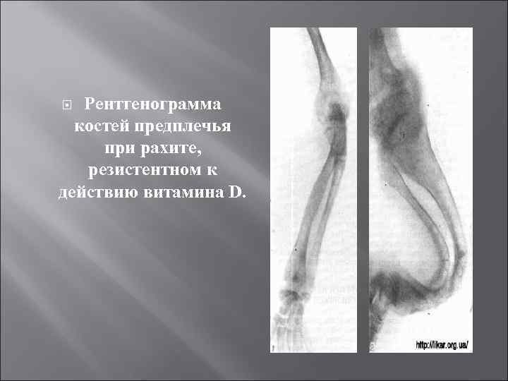 Рентгенограмма костей предплечья при рахите, резистентном к действию витамина D. 