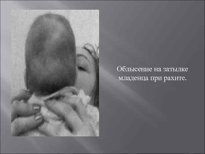  Облысение на затылке младенца при рахите. 