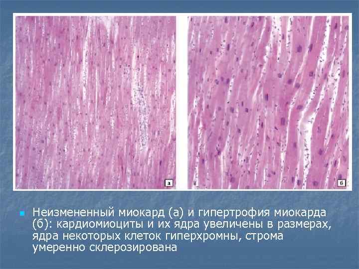 n Неизмененный миокард (а) и гипертрофия миокарда (б): кардиомиоциты и их ядра увеличены в