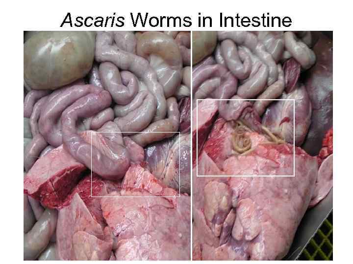Ascaris Worms in Intestine 