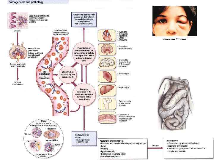 симптом Романа 