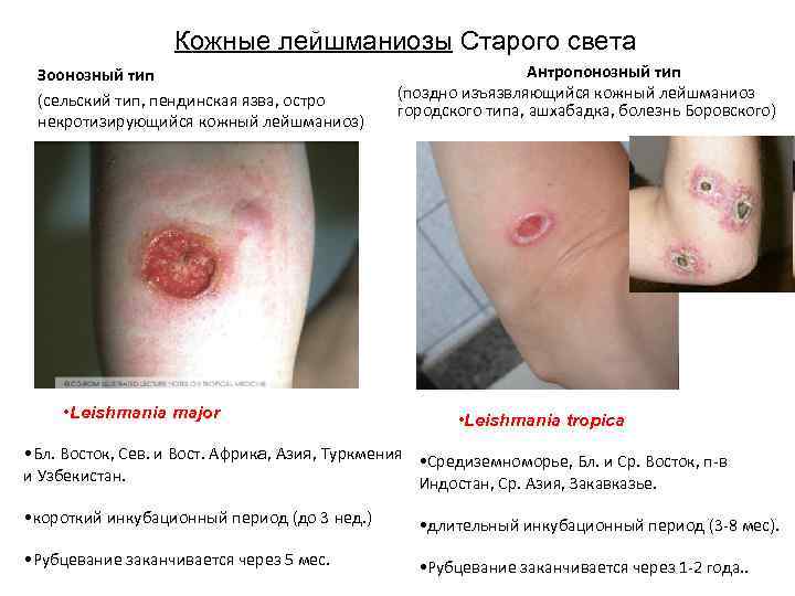 Кожные лейшманиозы Старого света Зоонозный тип (сельский тип, пендинская язва, остро некротизирующийся кожный лейшманиоз)