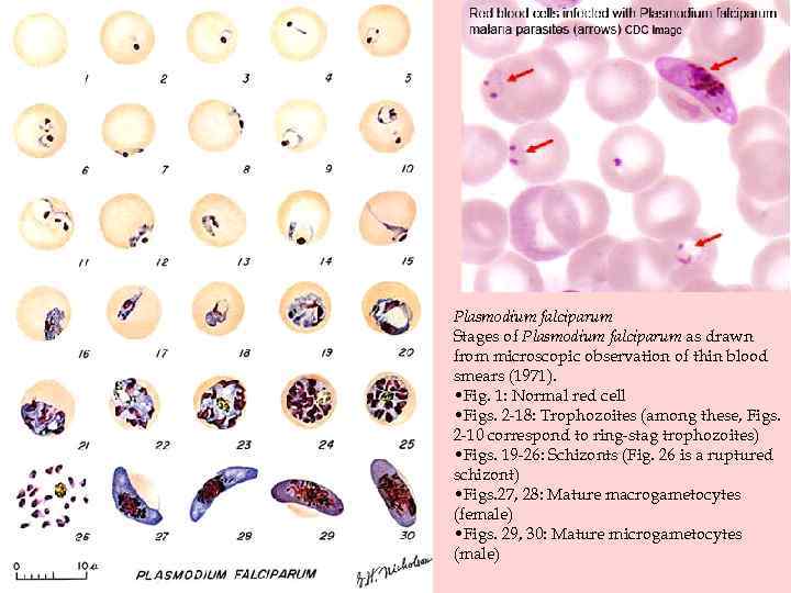 Plasmodium falciparum Stages of Plasmodium falciparum as drawn from microscopic observation of thin blood